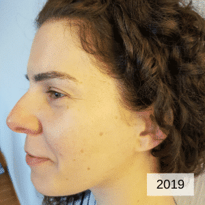 geraldine-acne-free